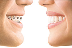 braces-profile